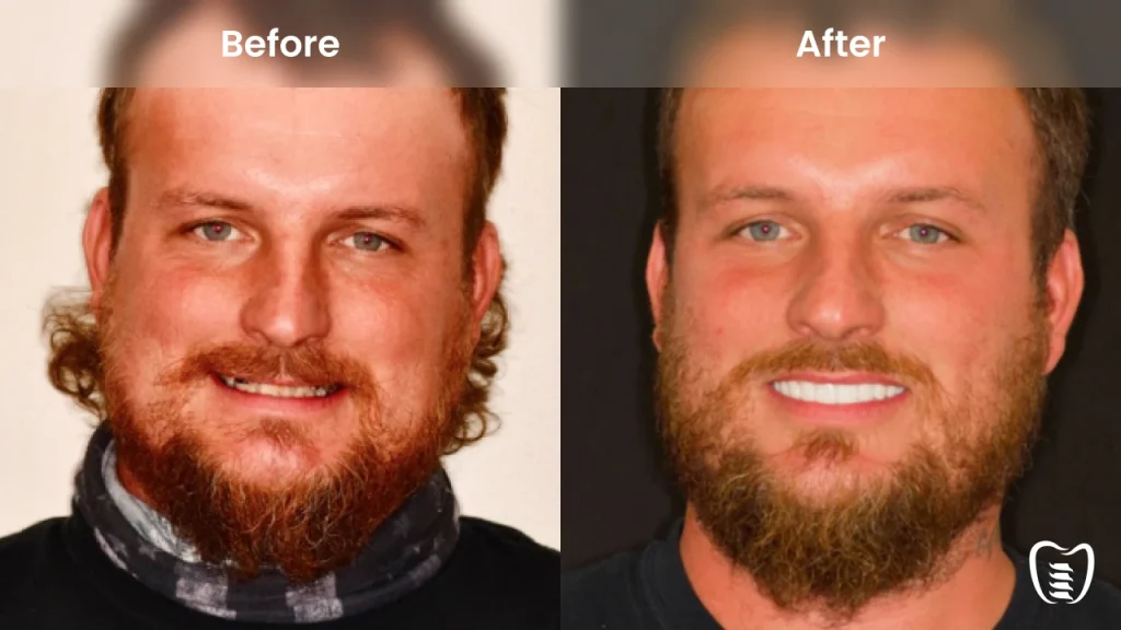Before and after dental implants at All On Implants Oklahoma City