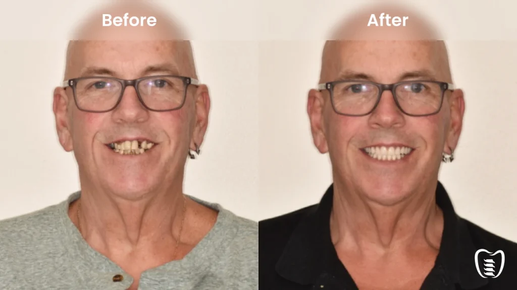 Before and after dental implants at All On Implants Oklahoma City
